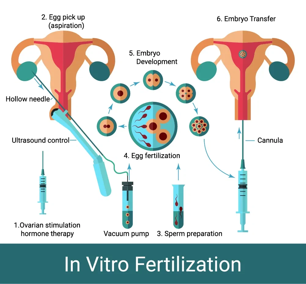 Učinkovitost različnih velikosti igel za iskanje jajc v postopkih IVF
