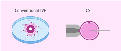 IVF Jajce iskanje: Odgovorjena na pogosta vprašanja